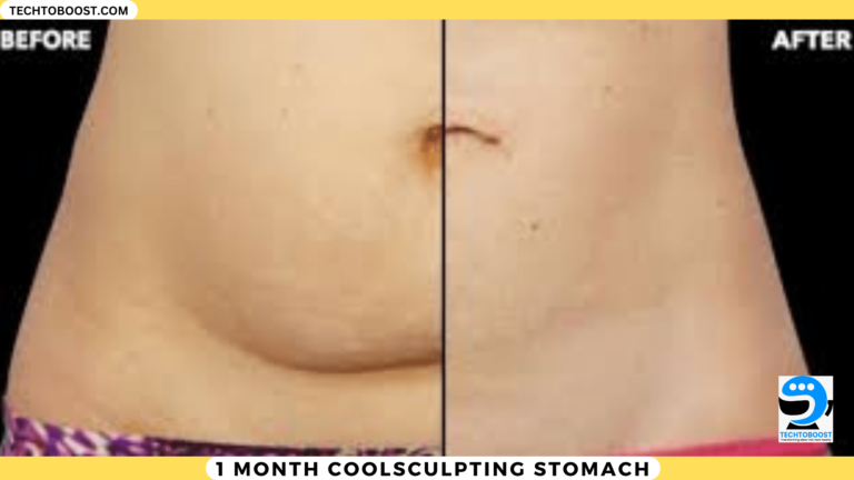 1 Month Coolsculpting Stomach
